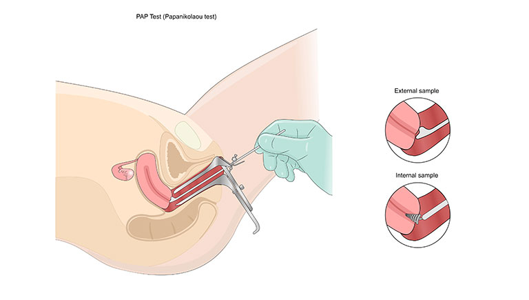 Pap smear meaning